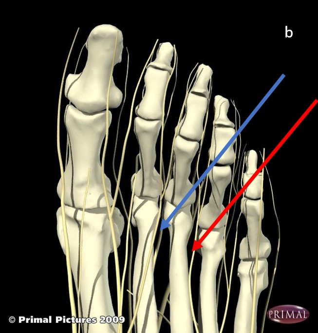 Morton’s Neuroma by Jacqueline Horne - Erica Dash Podiatry
