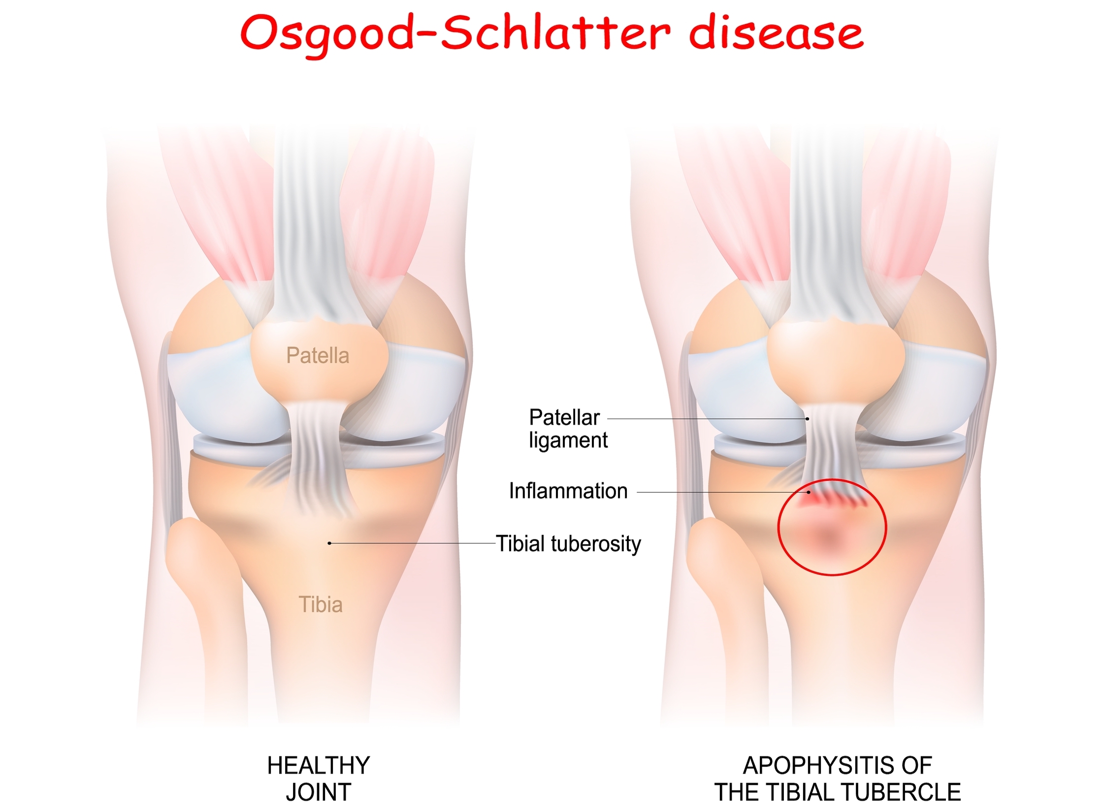 Osgood Schlatters Disease