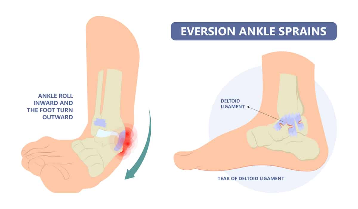 Eversion Ankle Sprains