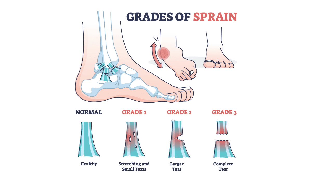 Severity of Ankle Sprains